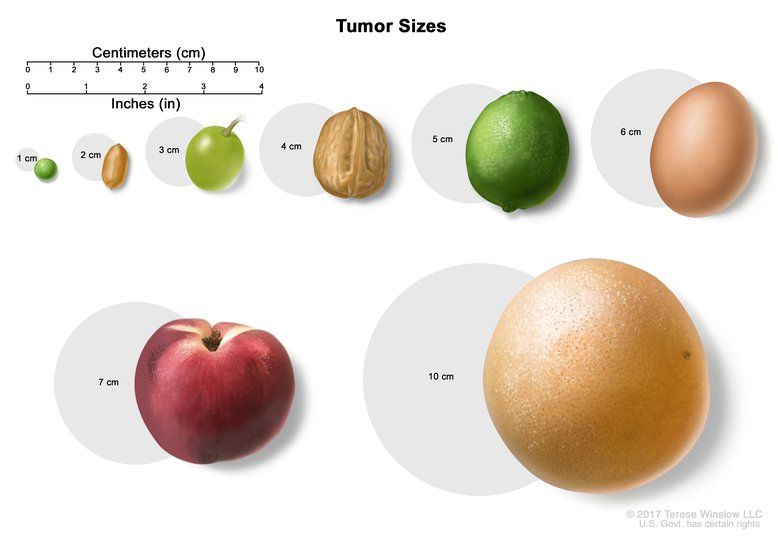 Tumor size in centimeters relative to everyday objects.