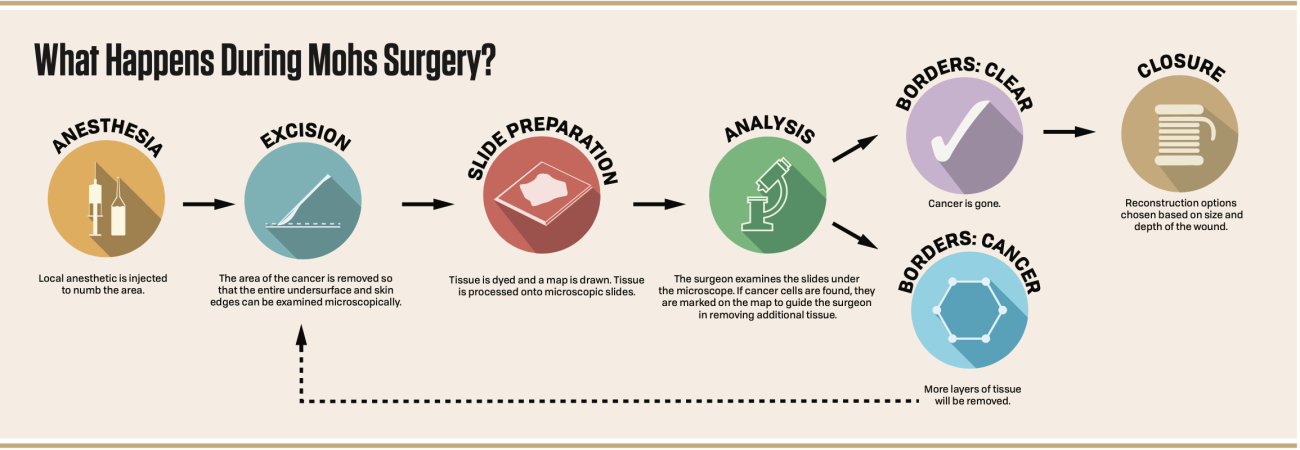 Infographic explaining what to expect when undergoing Mohs surgery.