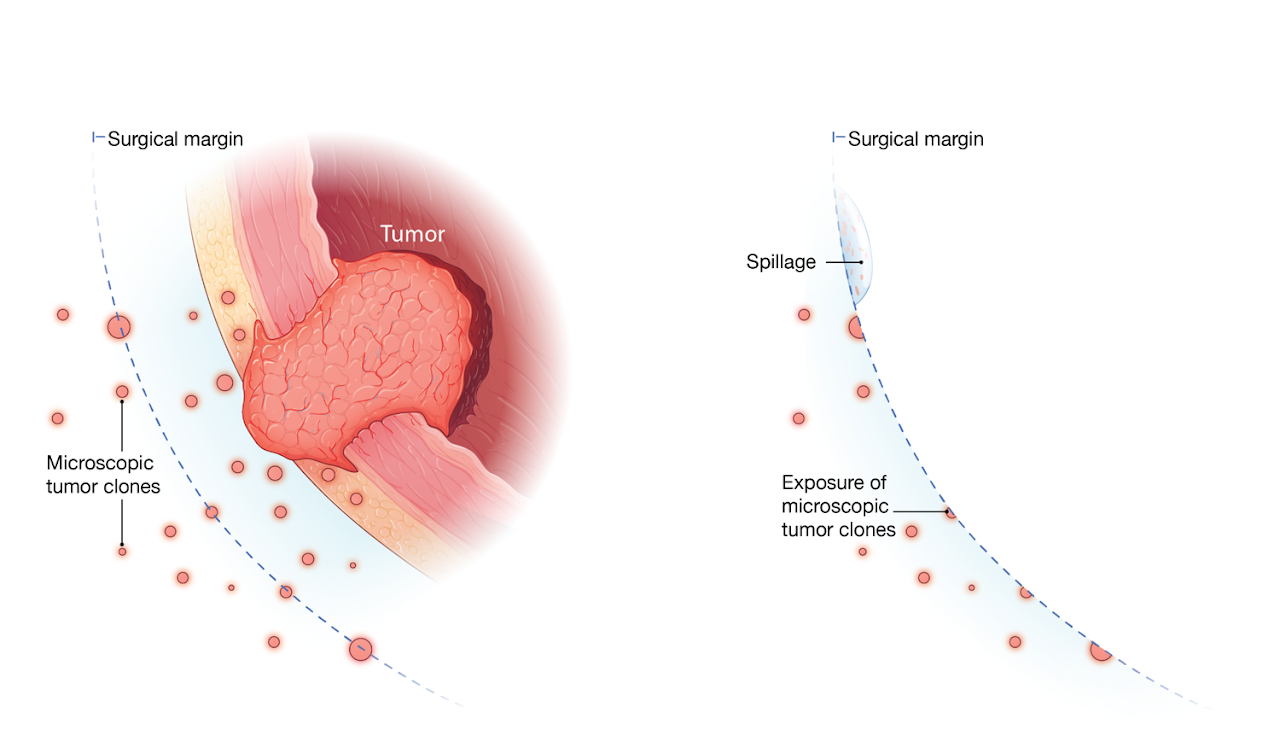 Pre-existing, microscopic tumor clones potentially contribute to bladder cancer recurrence after surgery.