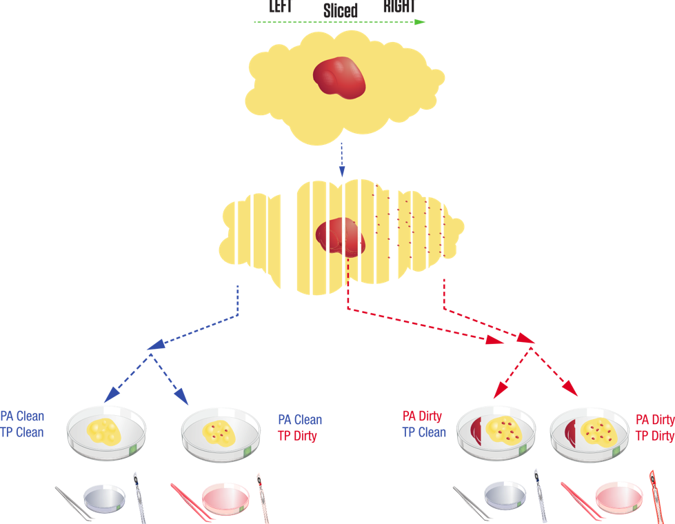 nadvertent handling during sample grossing and tissue procurement results in tumor contamination in the adjacent normal tissue]