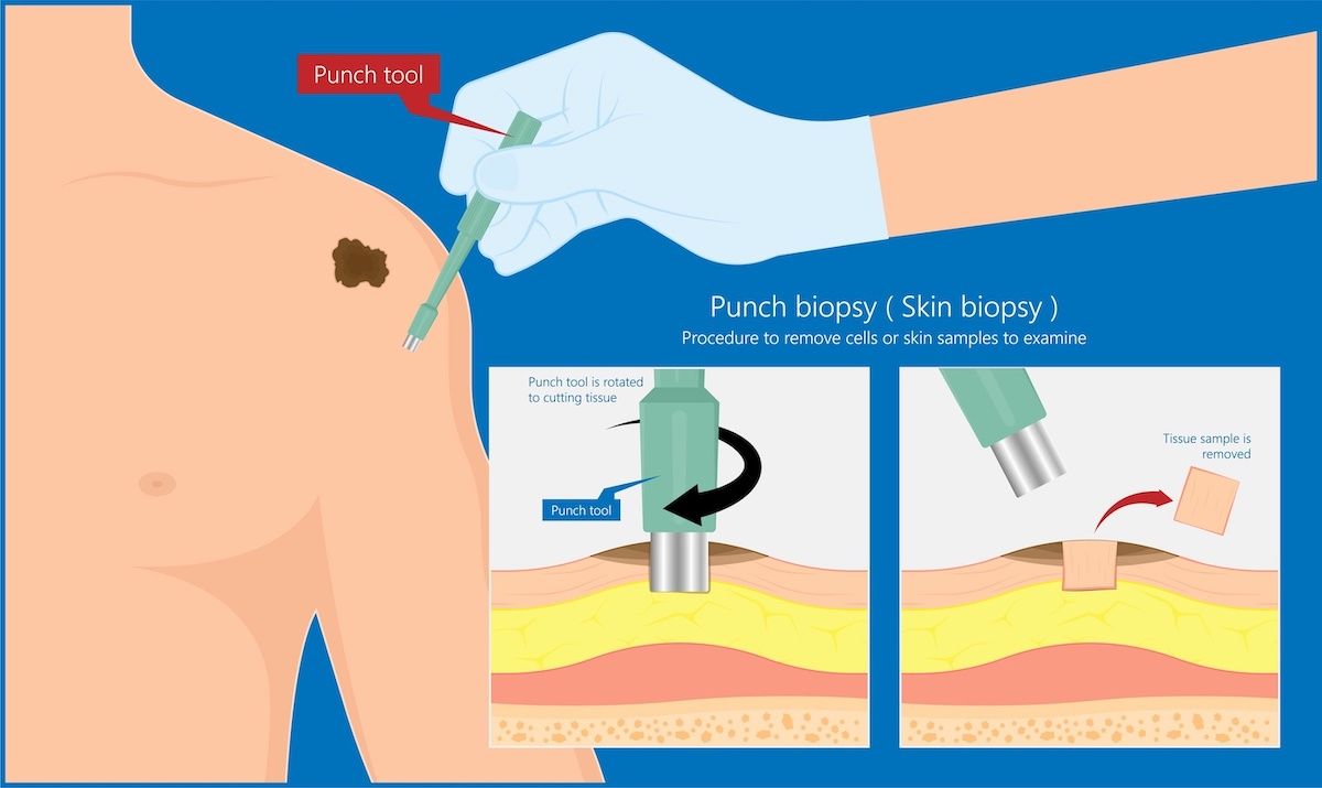 medical illustration of punch biopsy