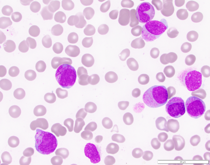 AML Image for Hematopathology Fellowship page 