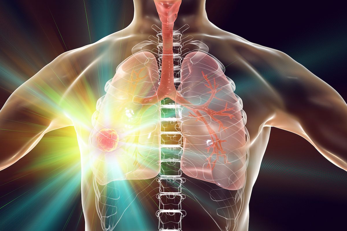 Non-small cell lung tumor graphic - stock