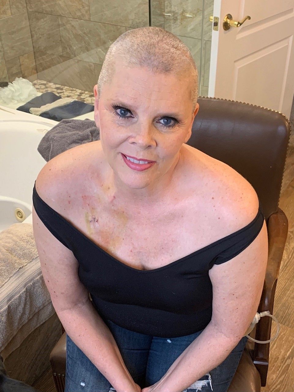 Shae Peters-Skarbowski after breast cancer surgery 
