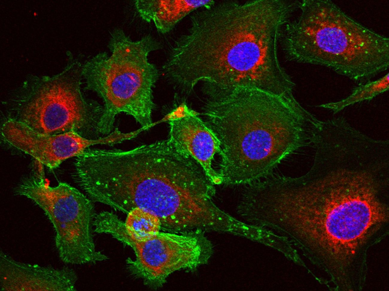 Ovarian cancer cells under a microscope