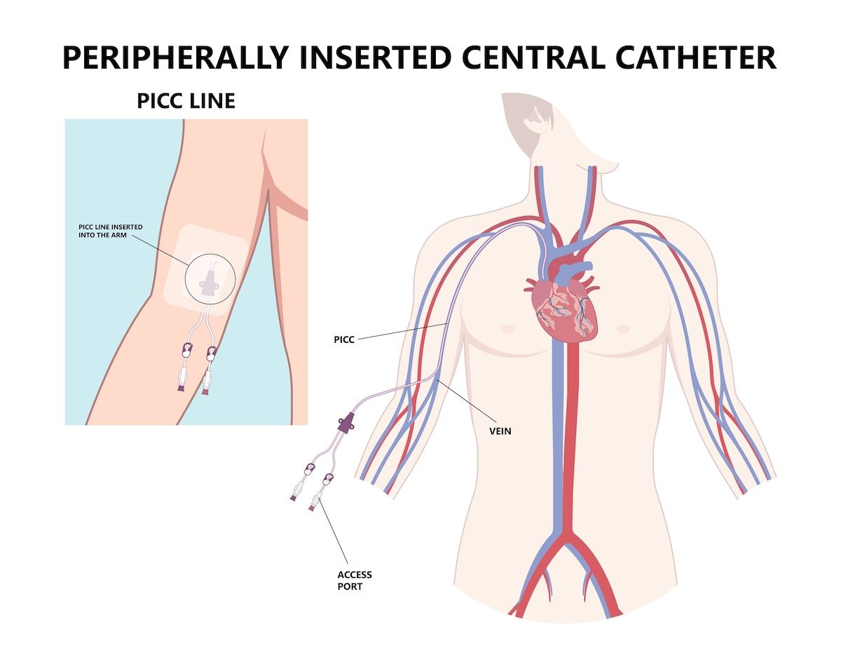 A drawing of the arm and a diagram of the body shows where a PICC line is inserted and how it is used.