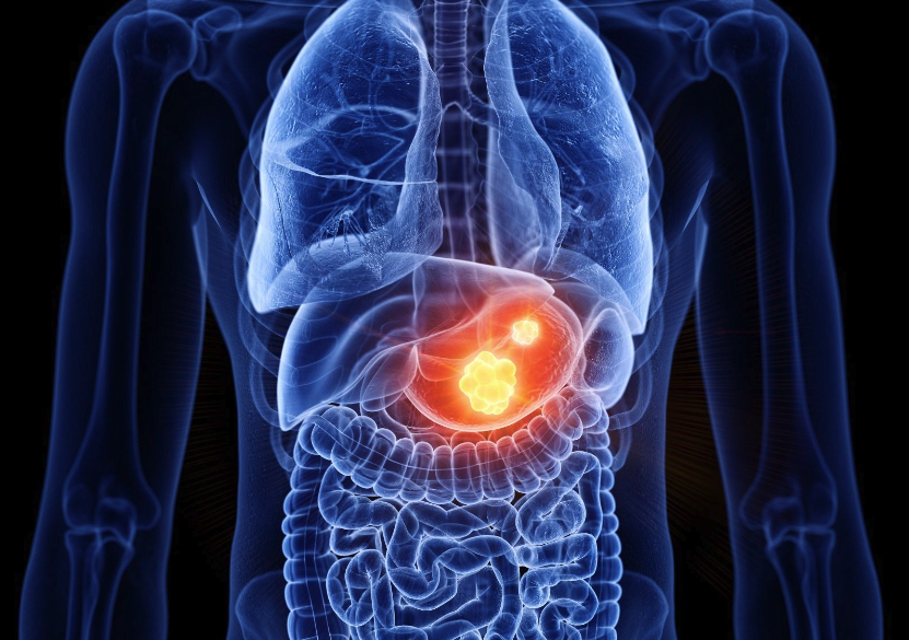 Image of chest and abdominal cavity with stomach cancer highlighted