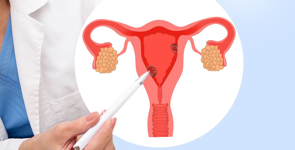 Diagram of uterus with polyps