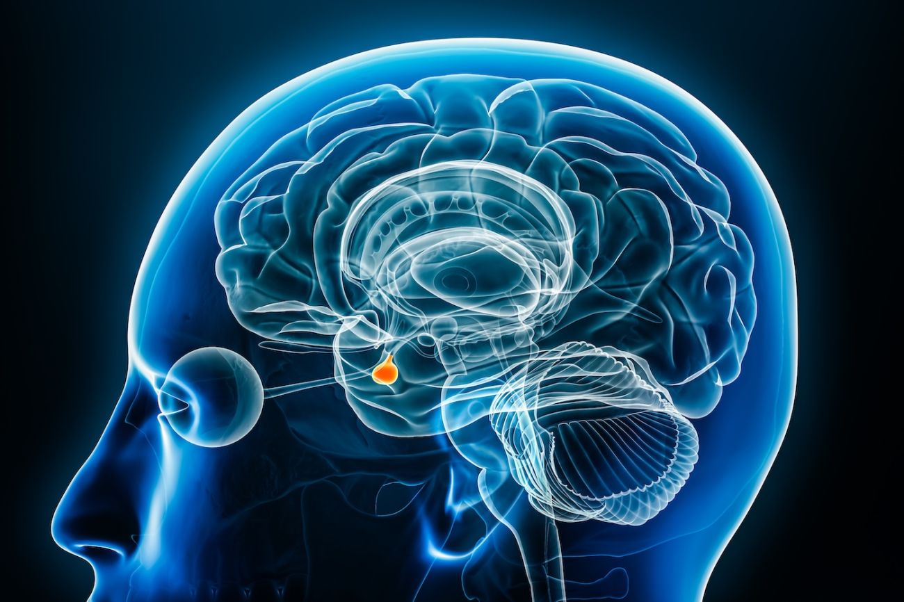 pituitary tumor