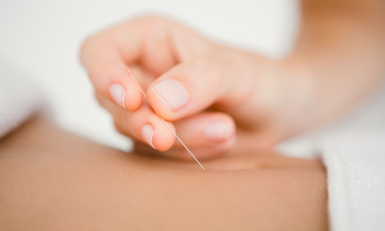 An acupuncturist prepares to insert an acupuncture needle into a patient's back