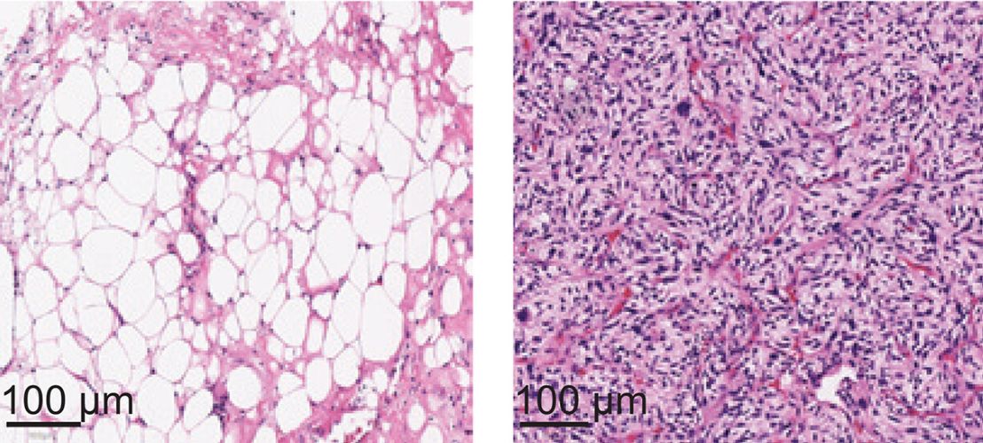 Microscope slides of liposarcoma 