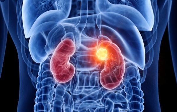 Photo of kiudney tumor