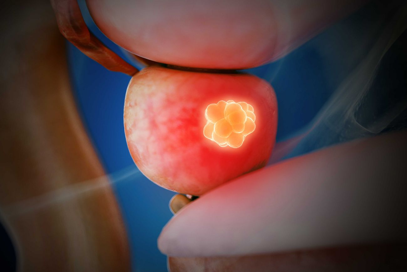 Medical illustration of the prostate