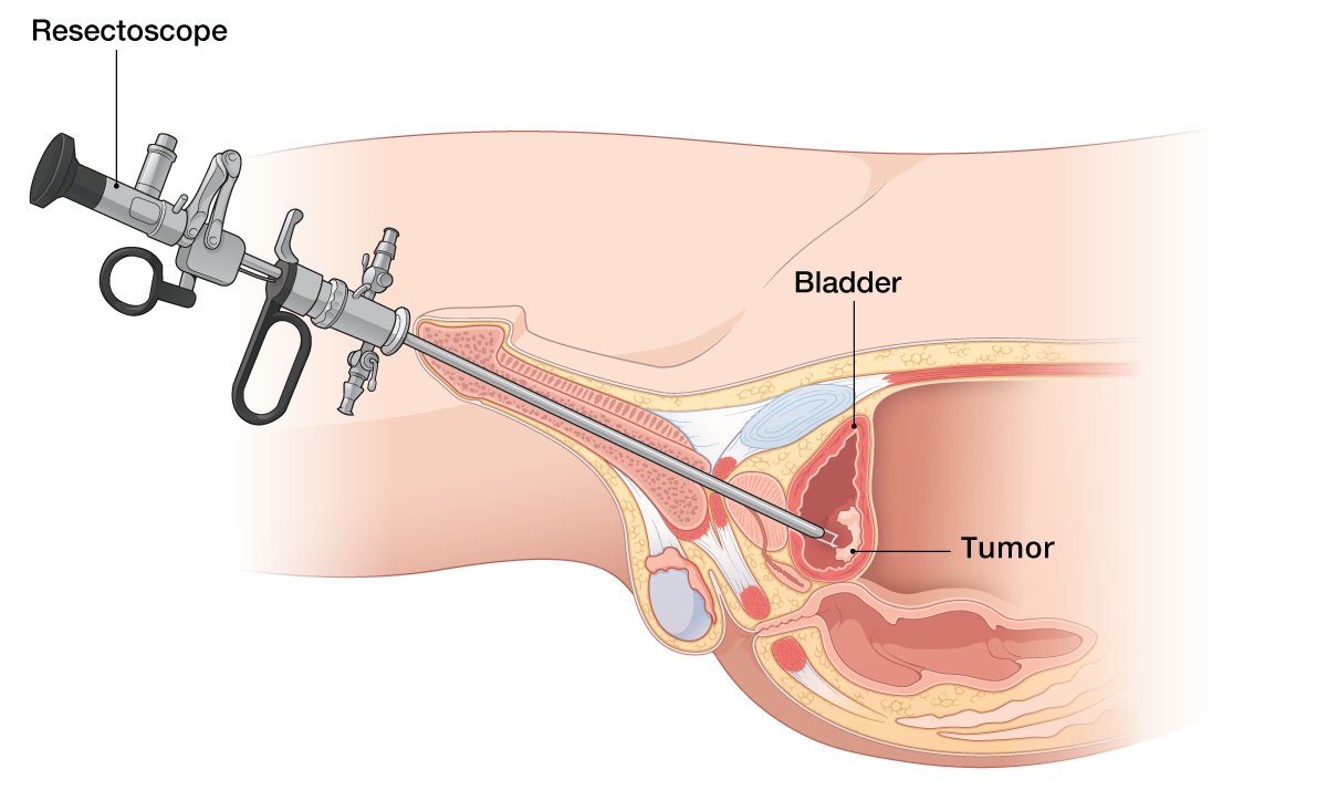 Diagram of TURBT procedure being performed to reach a bladder tumor