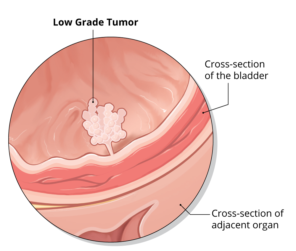 Diagram of low grade tumor