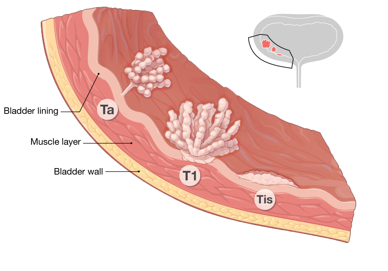Diagram of tumor types Ta, T1, and Tis in the bladder