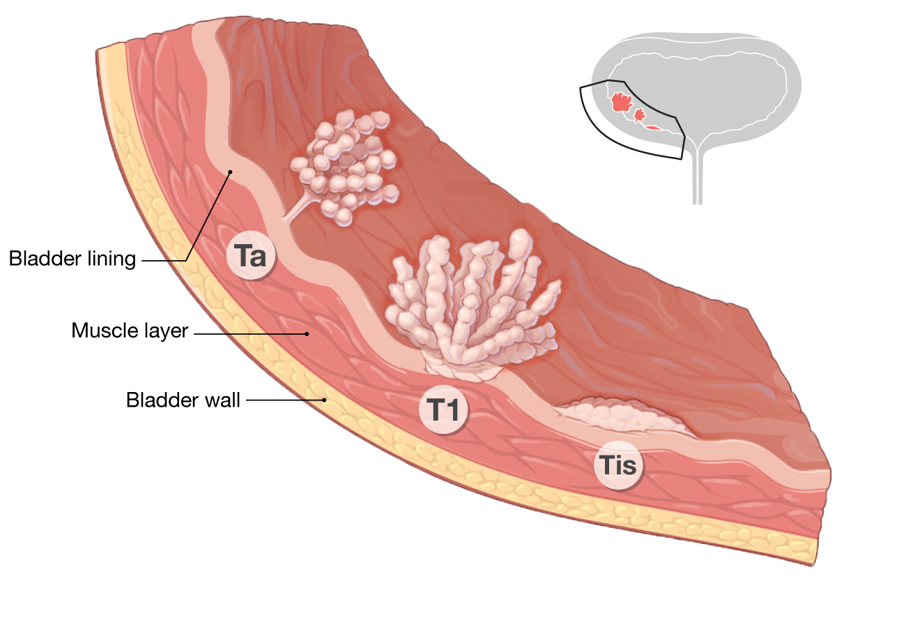 Bladder Cancer Staging Roswell Park Comprehensive Cancer Center bladder-cancer-staging-roswell-park-comprehensive-cancer-center