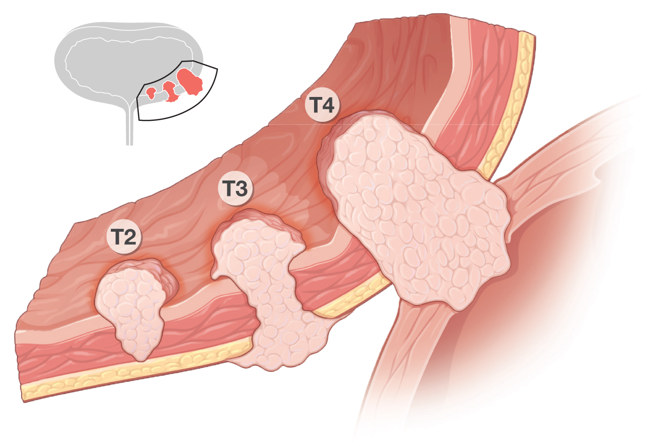 Diagram of tumor types T2, T3, and T4 in the bladder