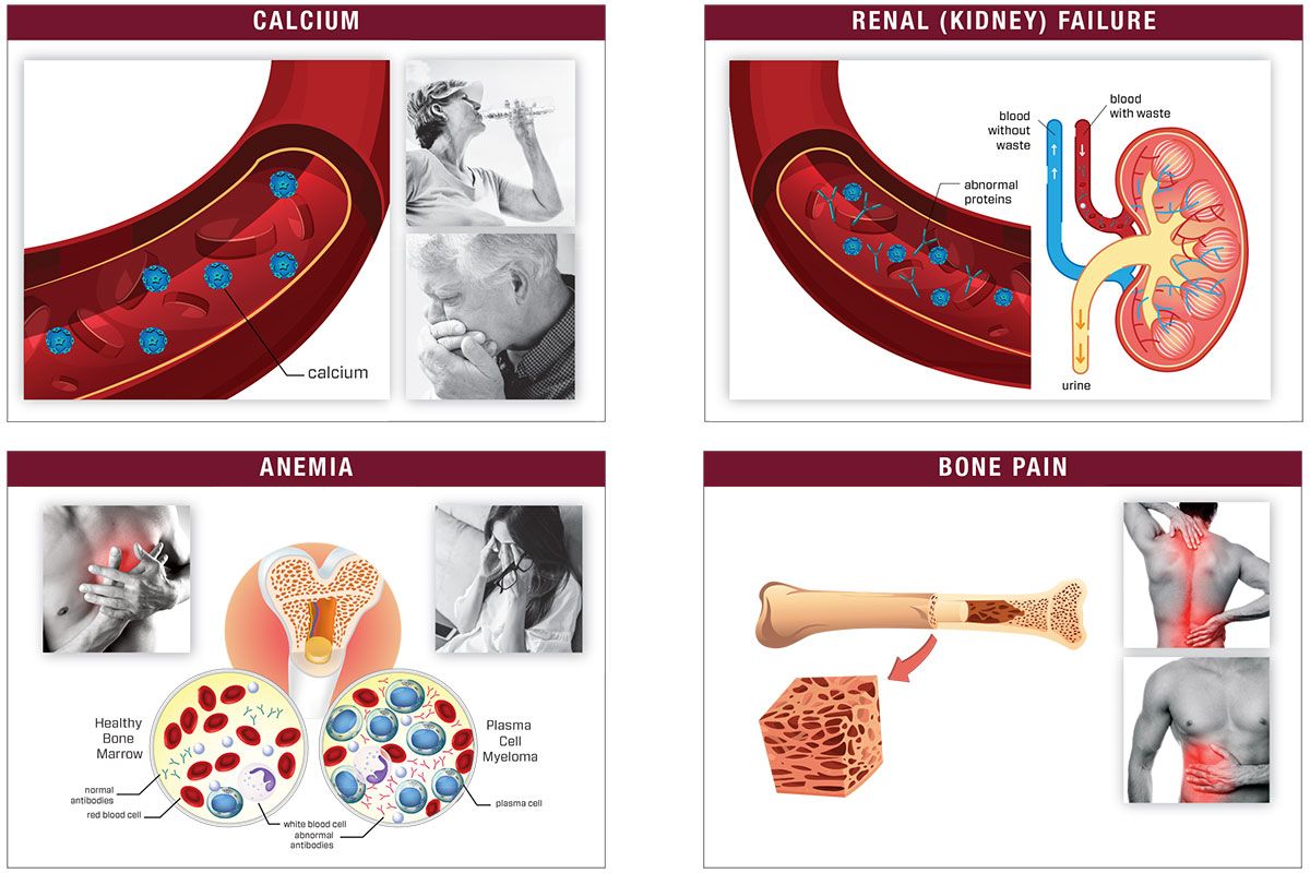 CRAB Symptoms of Multiple Myeloma