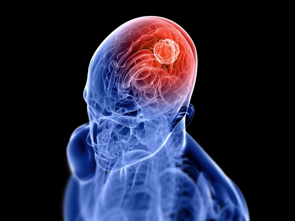 Illustration of tumor within a brain