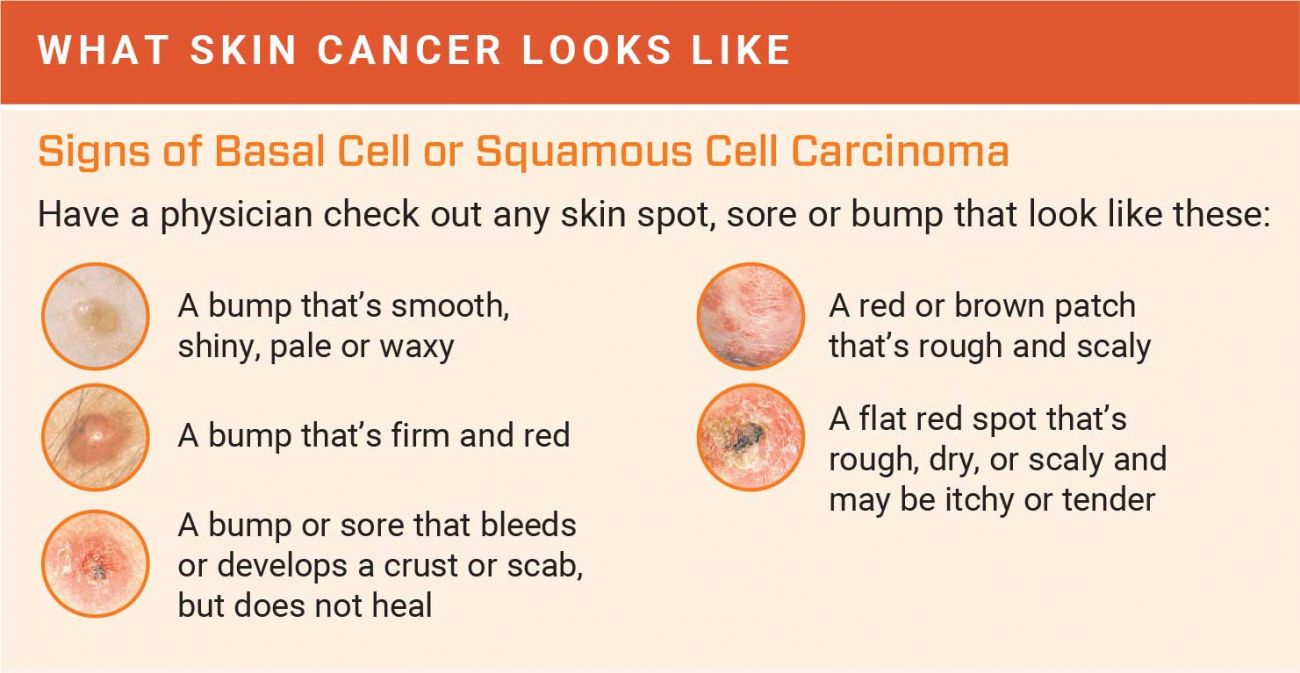 How To Detect Skin Cancer Roswell Park Comprehensive Cancer Center Images