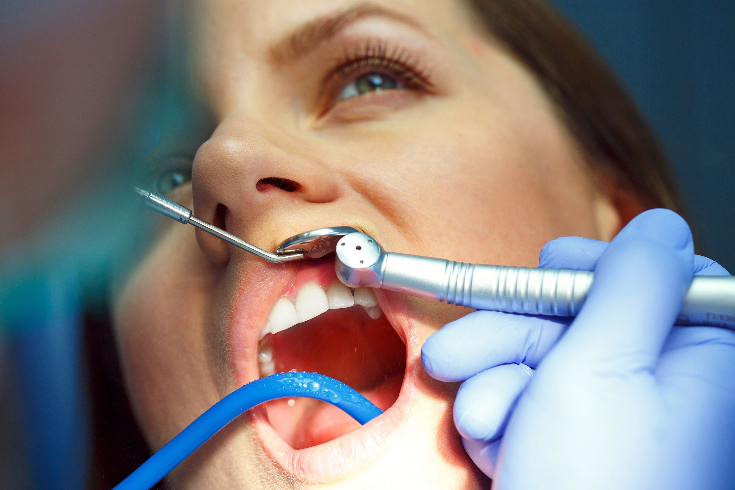 Can the Mercury in Dental Fillings Cause Cancer? Roswell Park