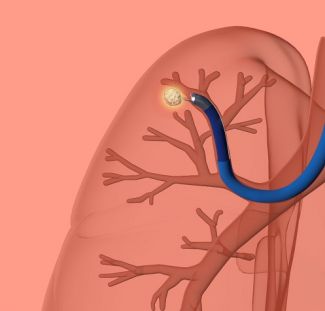 Robotic Bronchoscopy | Roswell Park Comprehensive Cancer Center