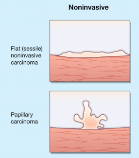 Diagram of differences between noninvasive tumors