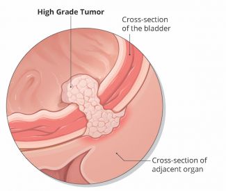 Diagram of a high grade tumor