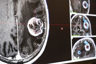 The new technology enables the Gamma Knife to operate with more precision