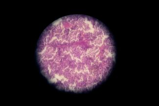 Neuroendocrine carcinoid under microscope