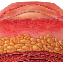 An illustration of a cross section of a radiation burn