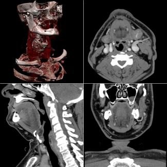 Imagine of a patient's head and neck area