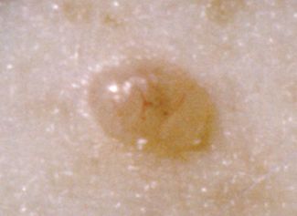 Signs of Skin Cancer - a bump that's pale and waxy 