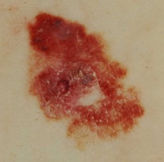 Signs of Skin Cancer - Red and bleeding 
