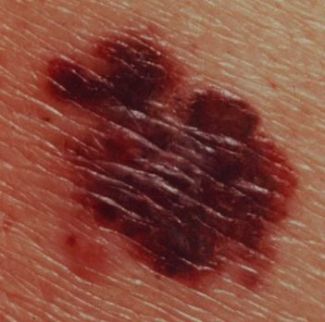 Signs of Skin Cancer - Red and flat 