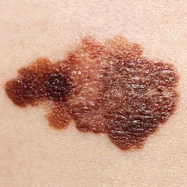 Signs of Skin Cancer - Asymmetrical shape