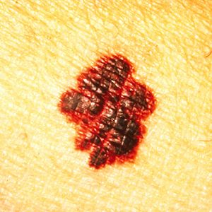 Signs of Skin Cancer - Borders are irregular