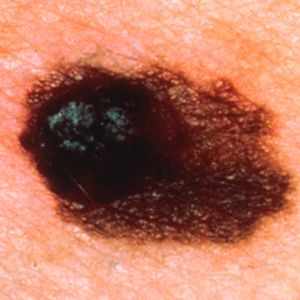 Signs of Skin Cancer - Evolving Shape 