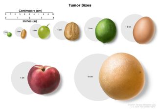 Tumor size in centimeters relative to everyday objects.