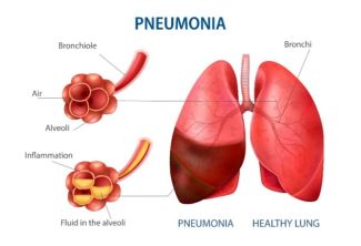 Diagram of lungs with pneumonia - stock 