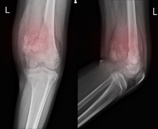 X-ray of a knee showing a soft tissue mass sarcoma - stock