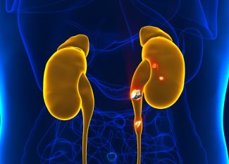 Graphic showing kidney stones forming in the kidney