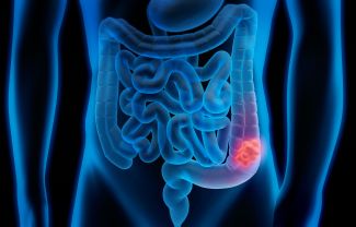 colon cancer in women