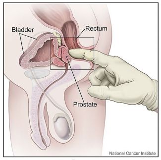 prostate exam nhs)