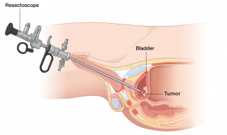 Diagram of TURBT procedure being performed to reach a bladder tumor