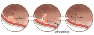 Diagrams showing how a resectoscope can reach and resect tumors within the bladder