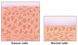 Diagram of difference between normal cells and cancer cells