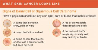 Mole Chart For Skin Cancer